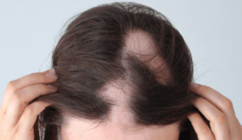 Causes & Solutions for Thinning Hair